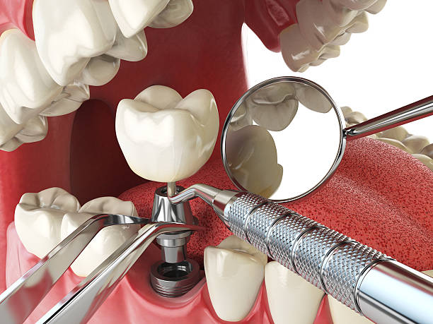 Best Emergency Dental Care for Abscessed Tooth in West Bishop, CA